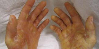 Skin like butterfly wings: UP scientists investigate rare deadly disease